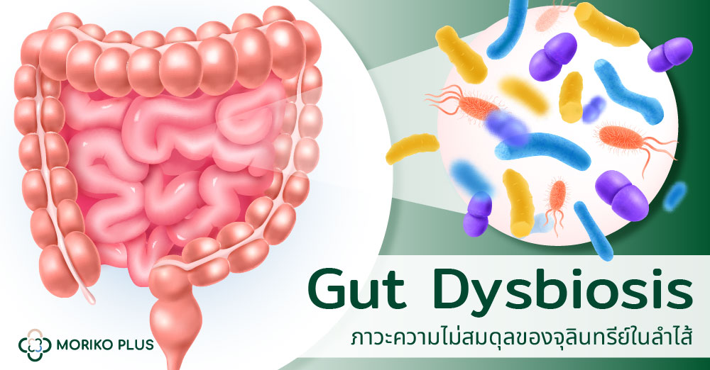 Gut Dysbiosis ภาวะความไม่สมดุลของจุลินทรีย์ในลำไส้